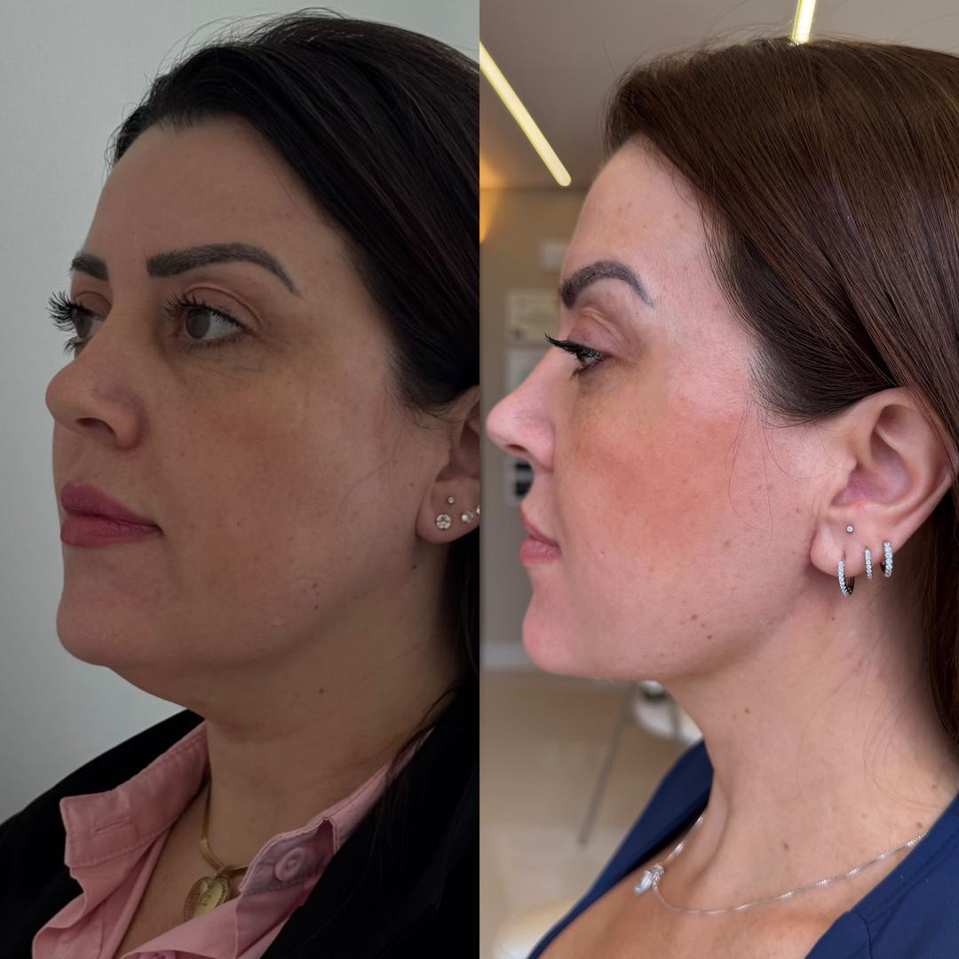 Contorno cervical: comparação entre o quadro inicial e o resultado